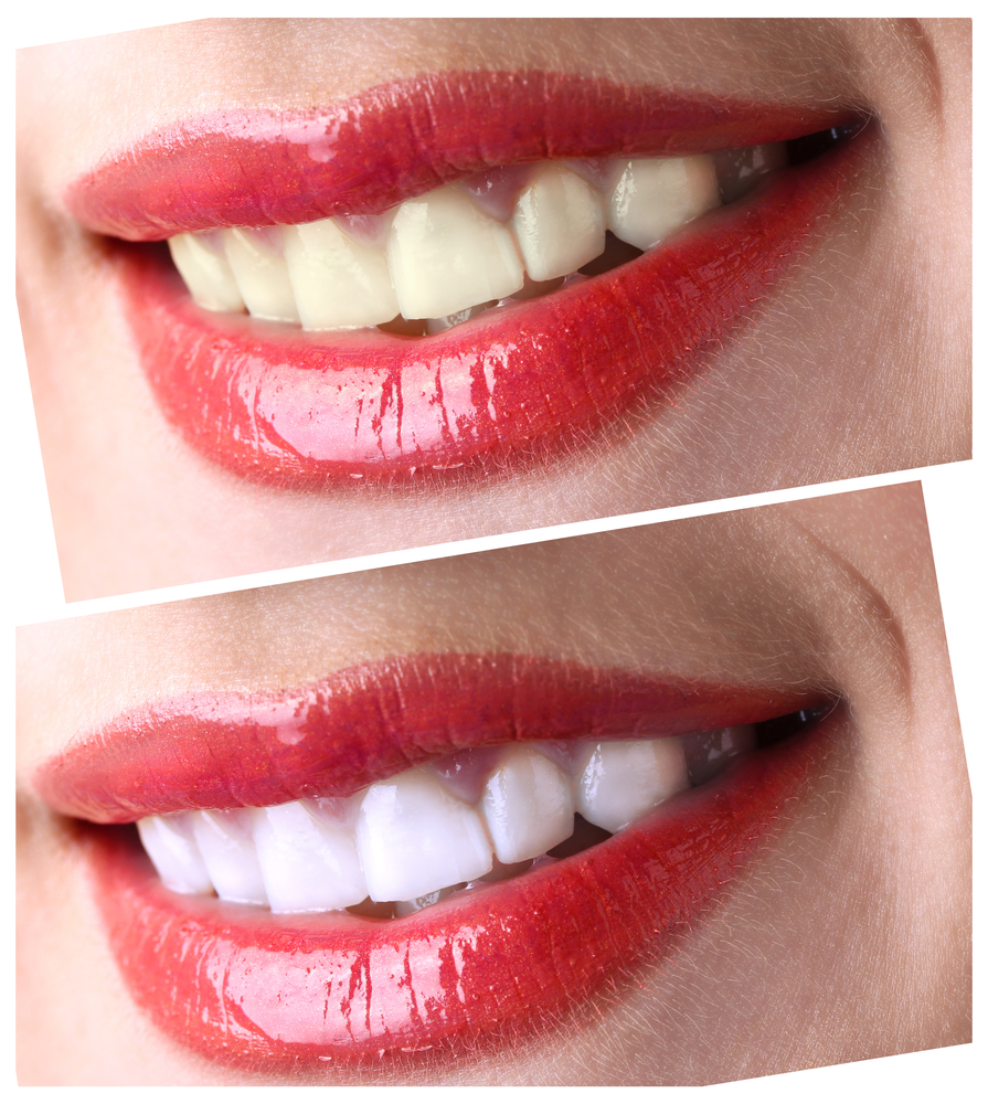 A Dentists Guide To The Sapphire Teeth Whitening System King within Teeth Whitening Side Effects
