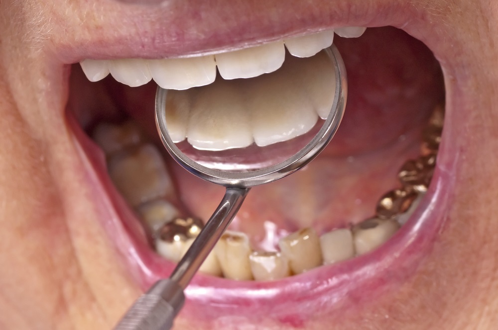 an-introduction-to-gold-dental-crowns-their-uses-throughout-history