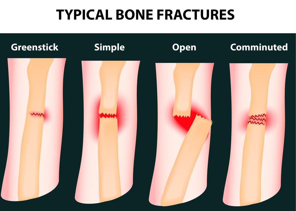 A Focus On Orthopedic Surgery How Long Do Broken Bones Take To Heal 