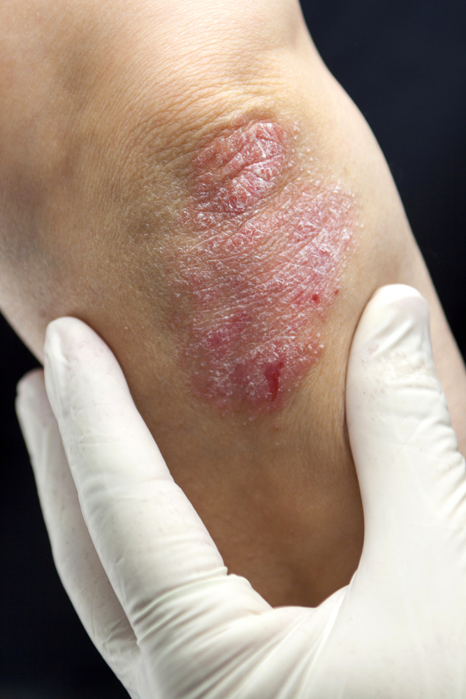 Dermatologist in Pinehurst area Explains Psoriasis - Asheboro ...