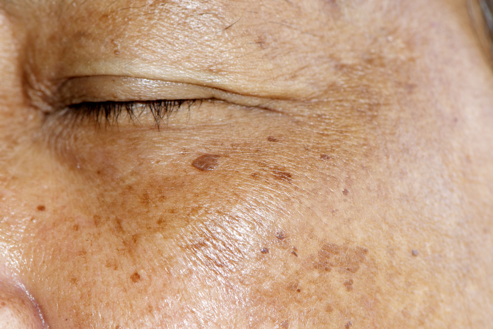 How To Decipher Between Age Spots And Skin Cancer Lauren A Daman Md Pc