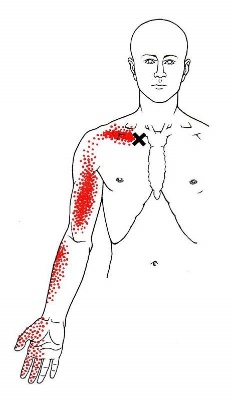 Arm, Wrist and Hand Pain - Thoracic Outlet Syndrome or Myofascial ...